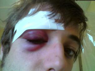 Black Eye 1