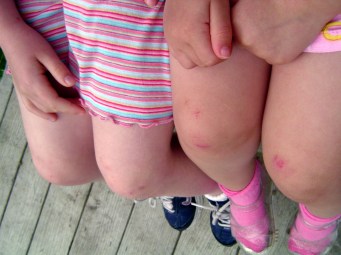 Scraped Knees